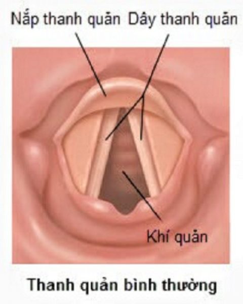Phẫu thuật cắt hạt xơ dây thanh là cách điều trị cần thiết với mục đích trả lại sự mềm mại của dây thanh