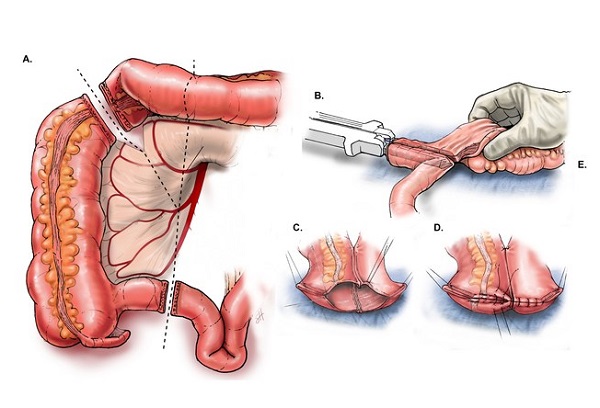 Phẫu thuật ung thư đại tràng là phương pháp lấy đi một phần hoặc toàn bộ đại tràng bị bệnh.