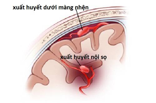 4. Lưu Ý Quan Trọng Khi Phẫu Thuật Xuất Huyết Não