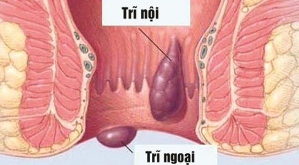 Trong số các cách điều trị bệnh trĩ hiện nay, phương pháp thắt mạch búi trĩ dưới hướng dẫn của siêu âm doppler gọi tắt là phẫu thuật DGHAL-RAR đã và đang được ứng dụng rộng rãi tại nhiều nước Châu Âu.