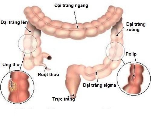 Polyp đại tràng nói chung, polyp đại tràng ngang nói riêng hầu hết là lành tính, song một số polyp đại tràng có thể phát triển thành ung thư