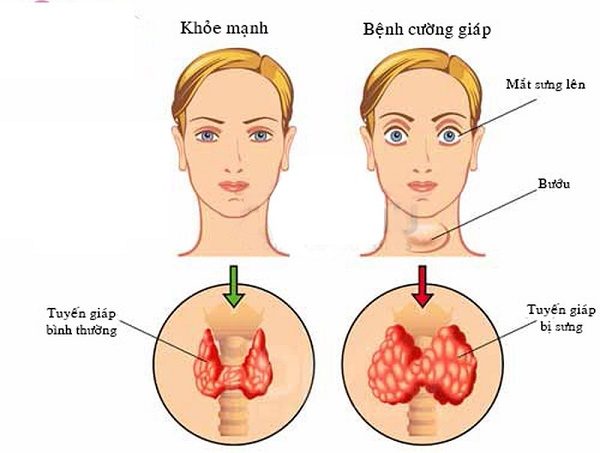 cường giáp triệu chứng và cách điều trị
