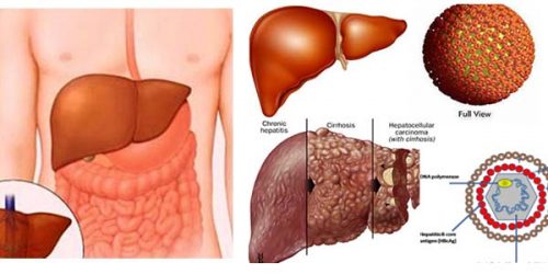 Viêm phúc mạc nhiễm khuẩn tiên phát thường gặp ở bệnh nhân xơ gan và bệnh nhân gan giai đoạn cuối.