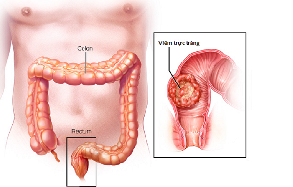 Viêm trực tràng là chỉ tình trạng viêm ở lớp niêm mạc hay các tổ chức xung quanh trực tràng. 