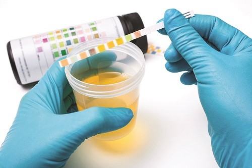 Xét nghiệm nước tiểu cho chỉ số bạch cầu dương tính nghĩa là tỷ lệ bạch cầu cao hơn mức bình thường