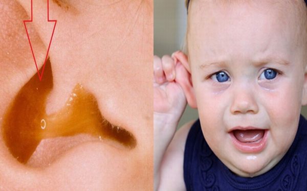 Biến chứng bệnh viêm tai giữa ở trẻ em có thể dẫn đến tình trạng thủng màng nhĩ