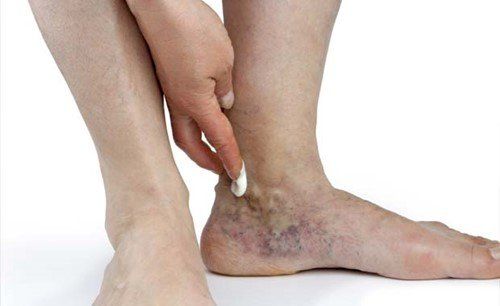 Hình ảnh trẹo cổ chân