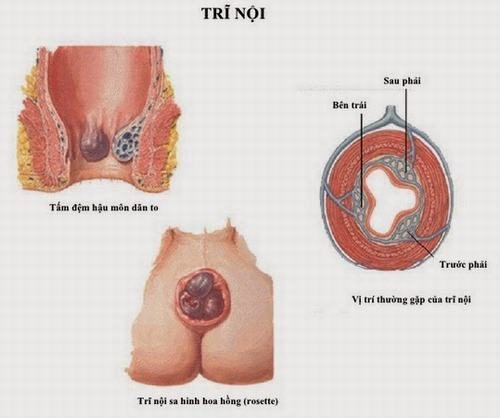 Tùy từng trường hợp bệnh nhân với mức độ bệnh khác nhau sẽ có giải đáp chính xác cho vấn đề có nên thắt búi trĩ không.