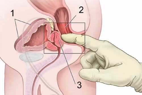 Thăm khám hậu môn giúp phát hiện ung thư hậu môn