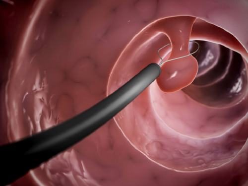 U dạ dày lành tính còn được gọi là polyp ở dạ dày