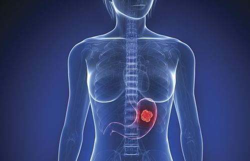 Khối u dạ dày ác tính hay còn gọi là ung thư, nguy hiểm và có thể gây tử vong nếu không điều trị sớm