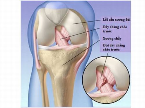 Nhiều bệnh nhân được chỉ định mổ đứt dây chằng đầu gối sau khi không may gặp tai nạn hoặc do chơi thể thao.