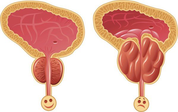 Mổ u xơ tiền liệt tuyến thế nào