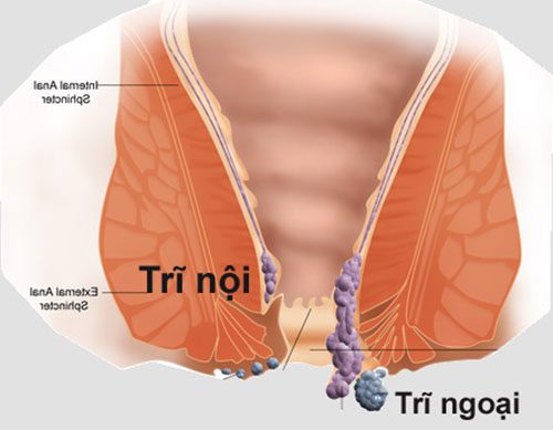 Bệnh Trĩ La Gi Nguyen Nhan Triệu Chứng điều Trị