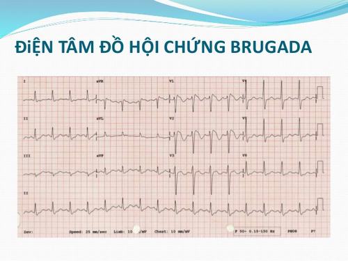 Hội Chứng Brugada và Điện Tim (ECG)