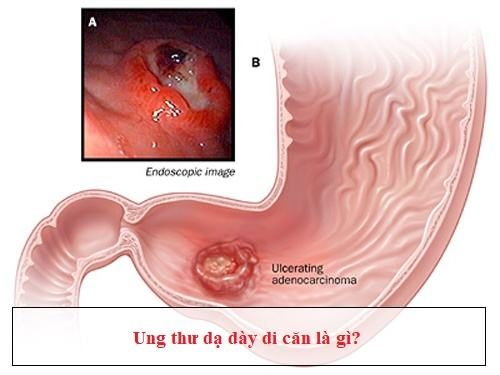 Ở giai đoạn cuối, tế bào ung thư phát triển to dần lên, gây ảnh hưởng nghiêm trọng tới sức khỏe