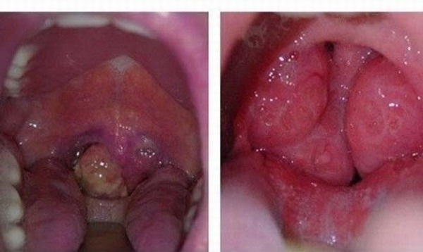 Ung thư vòm họng giai đoạn cuối tỷ lệ chữa khỏi không cao vì khối u đã phát triển to và di căn sang nhiều cơ quan khác nhau trong cơ thể.