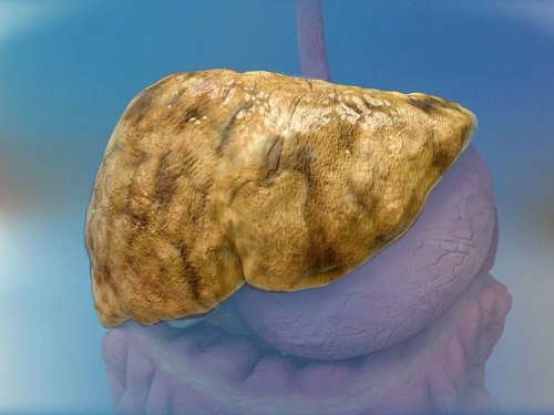 bệnh gan miễm mỡ