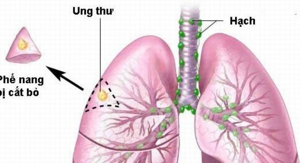 Ung thư phổi di căn hạch là giai đoạn cuối của bệnh ung thư