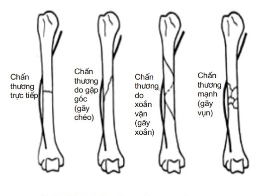 Các kiểu gãy xương cánh tay