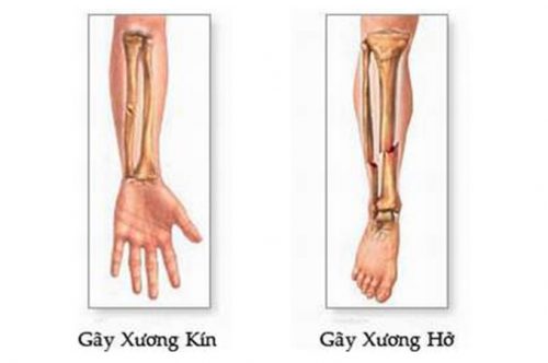 Biểu hiện của gãy xương