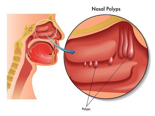 Polyp mũi là những khối mềm, không đau ở bên trong mũi, thường xuất hiện ở những xoang phía trên dẫn lưu về mũi