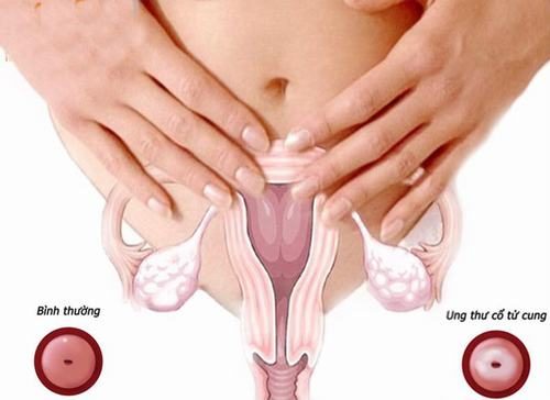 Chị em cũng cần cảnh giác với ung thư cổ tử cung