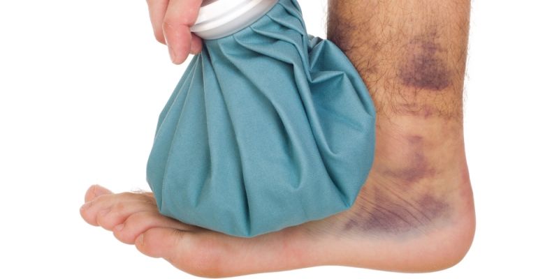 Khi bị trẹo chân, bạn không nên chườm nóng mà chỉ nên chườm lạnh bị trẹo chân có nên bôi dầu không