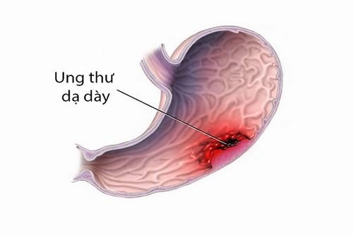 Ung thư dạ dày không được phát hiện và điều trị sớm sẽ chuyển biến sang giai đoạn nặng, di căn xa
