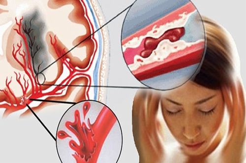 Rất nhiều người muốn tìm hiểu xuất huyết não có chữa được không.