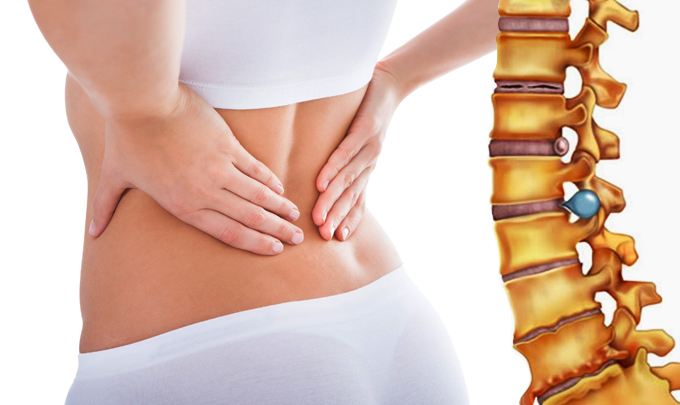 Nghiệm pháp Lasègue trong chẩn đoán hội chứng Thắt Lưng - Hông