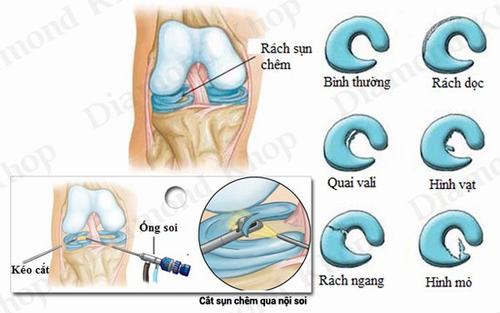Rách sừng sau sụn chêm trong có nhiều kiểu khác nhau tùy theo hình dạng, vị trí cảu chỗ rách