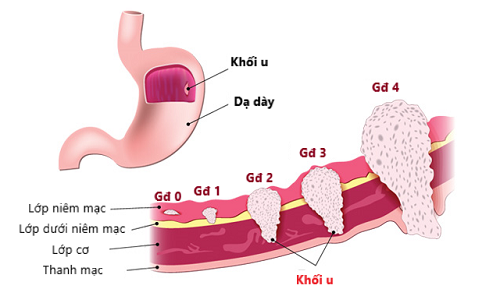 Ung thư dạ dày giai đoạn 2 là giai đoạn tiến triển của tế bào ung thư