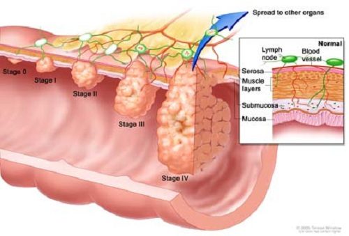 Ung thư đại tràng giai đoạn cuối là giai đoạn nặng, thường có tiên lượng sống thấp
