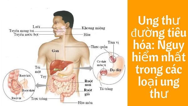 Ung thư đường tiêu hóa là bệnh nguy hiểm nhất trong tất cả các bệnh lý ung thư. 