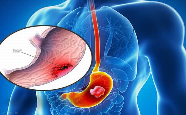 Ung thư dạ dày là bệnh lý thường gặp nhất ở đường tiêu hóa