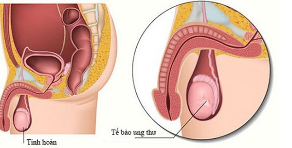 Ung thư có thể ghé thăm bất cứ ai, kể cả những người trẻ tuổi