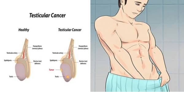 Tự khám tinh hoàn tại nhà giúp nam giới phát hiện sớm bất thường ở tinh hoàn