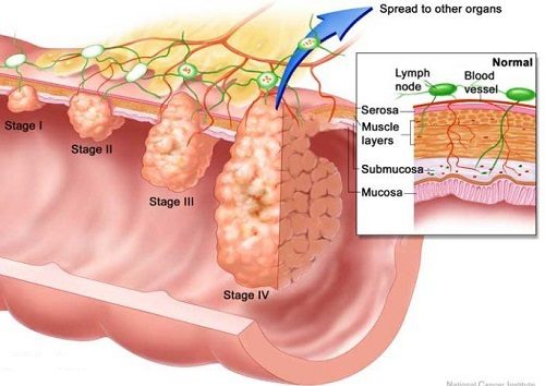 Ung thư trực tràng được chia làm 4 giai đoạn.