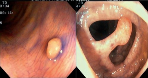 phan-biet-polyp-truc-trang-khong-cuong-va-co-cuong-02