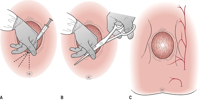 Vết rạch tầng sinh môn bị lồi có sao không