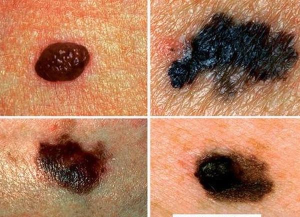 Nốt ruồi ung thư sẽ có những đặc điểm khác nốt ruồi bình thường