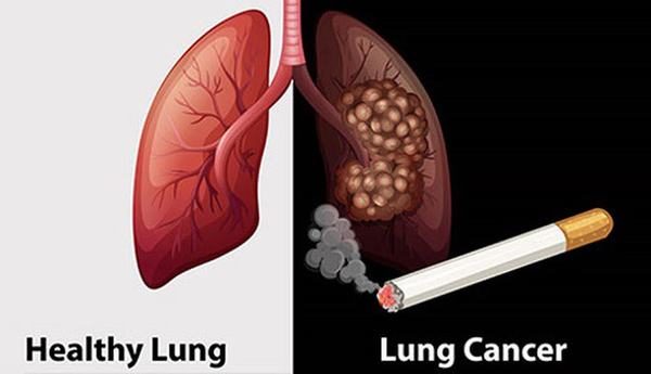 Thuốc lá là thủ phạm chính gây ung thư phổi