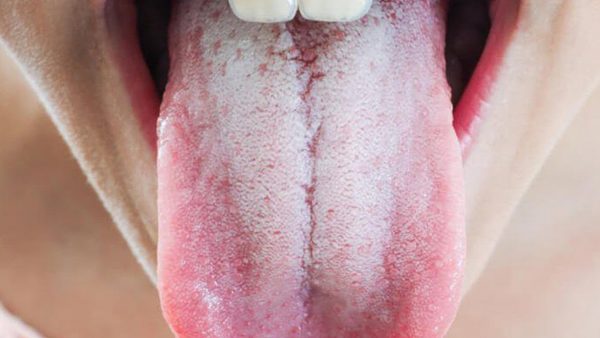 Lưỡi trắng xảy ra khi bề mặt của lưỡi bị nhiễm vi khuẩn, nấm hay các tế bào chết dính kẹt vào giữa các nốt đỏ của lưỡi khi không được vệ sinh sạch sẽ hoặc bệnh nhân đang mắc một số bệnh lý khác.