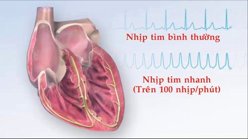 Nhịp tim bao nhiêu là bình thường là thắc mắc của nhiều người khi tìm hiểu về các vấn đề tim mạch.