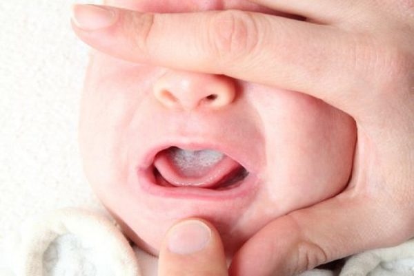 Trẻ sơ sinh sức đề kháng kém, chưa tự vệ sinh cá nhân nên các cặn sữa và thức ăn sẽ dễ đọng lại trên lưỡi nếu không được vệ sinh hay rơ lưỡi thường xuyên.