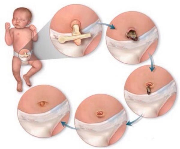 Hình ảnh về quá trình rụng rốn của trẻ sơ sinh