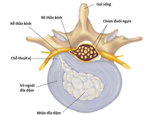 Hội chứng chùm đuôi ngựa xảy ra chủ yếu do thoát vị đĩa đệm