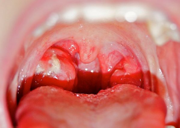 bệnh tai mũi họng ở trẻ hoàn toàn có thể chữa khỏi nếu được thăm khám sớm 
