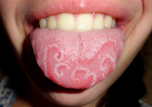 Viêm lưỡi bản đồ là bệnh lành tính, thường không gây nguy hiểm. Có thể điều trị bằng thuốc giảm đau, kháng viêm, thuốc bôi và vệ sinh theo sự chỉ định của bác sĩ